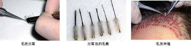 哪些人适合做头发种植手术?