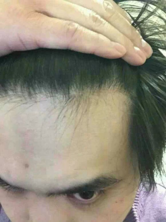 头发种植怎么样?靠谱吗?