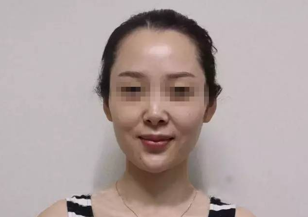 线雕只是面部年轻化中的一种方法