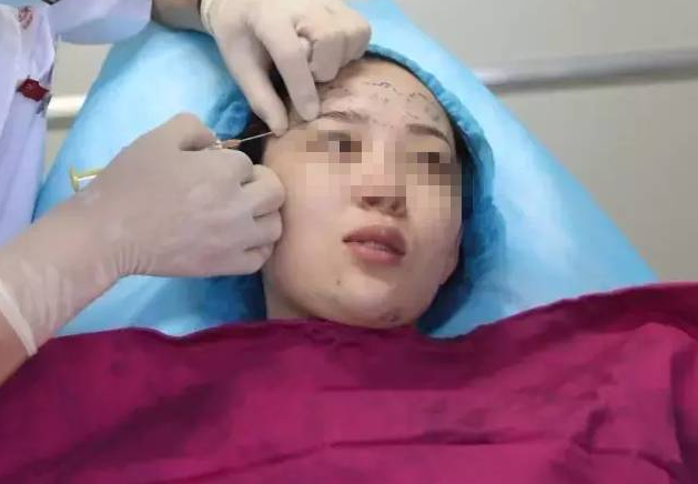 线雕只是面部年轻化中的一种方法