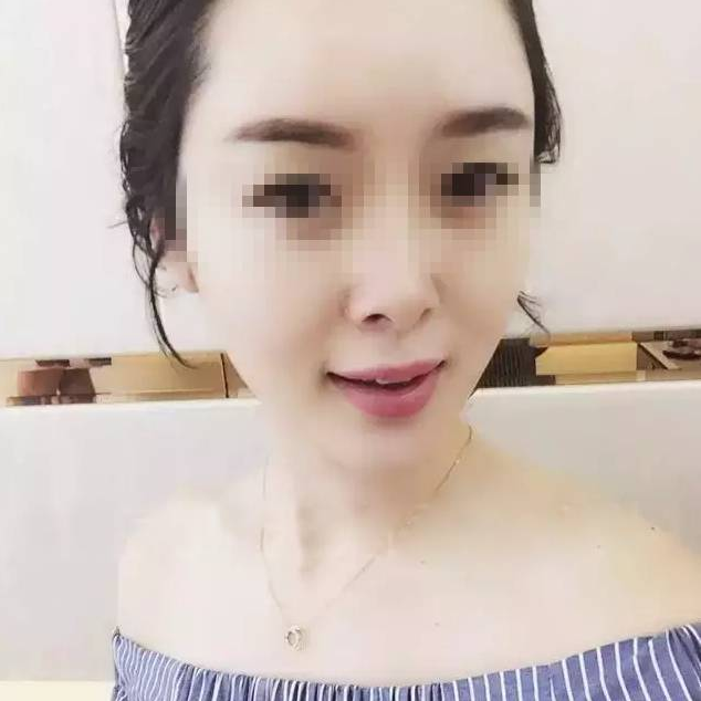 线雕只是面部年轻化中的一种方法
