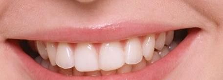 矫正牙齿的材料是选择金属托槽还是陶瓷托槽?