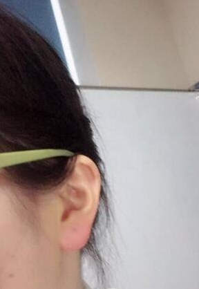玻尿酸丰耳垂的注射部位