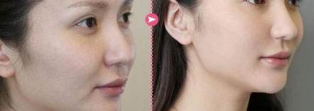 超声刀手术过程以及做完后的真实感受