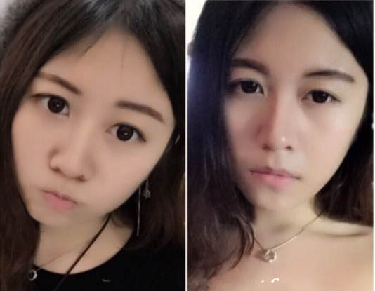 担心溶脂针没有效果的快看打完溶脂针的效果图