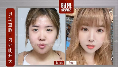 上海黄浦区这家医院割双眼皮效果居然这么好