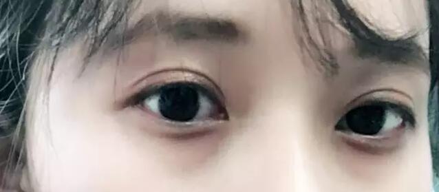 上海浦东新区这家医院割双眼皮既好看又自然