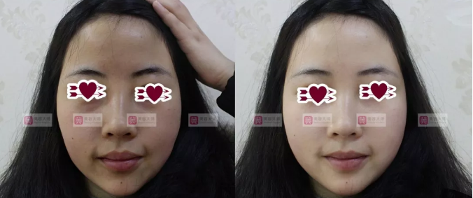 补充皮肤水分是选择敷面膜还是注射水光*?