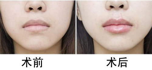 丰唇的常用方式及注意事项