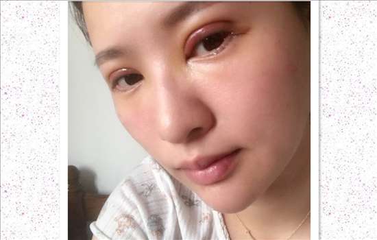 刚做完开眼角手术是尖的，现在回缩成圆的了
