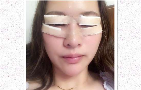 刚做完开眼角手术是尖的，现在回缩成圆的了