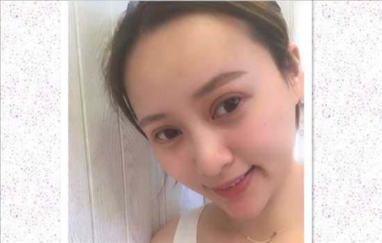 刚做完开眼角手术是尖的，现在回缩成圆的了