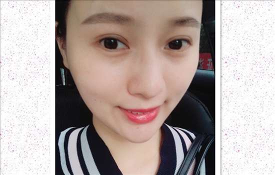 刚做完开眼角手术是尖的，现在回缩成圆的了