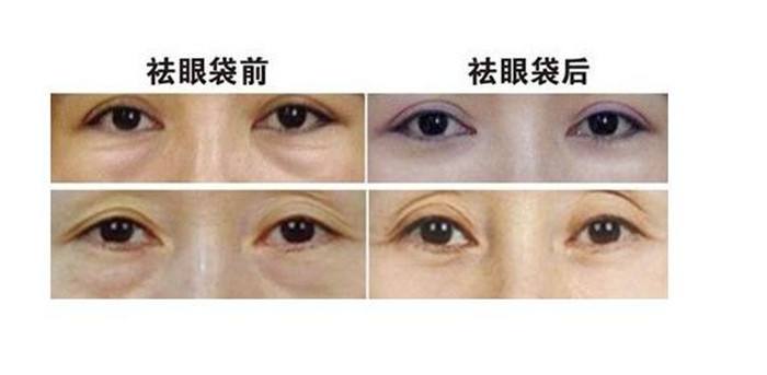 哪一种祛眼袋手术方法更好保持的时间更长久
