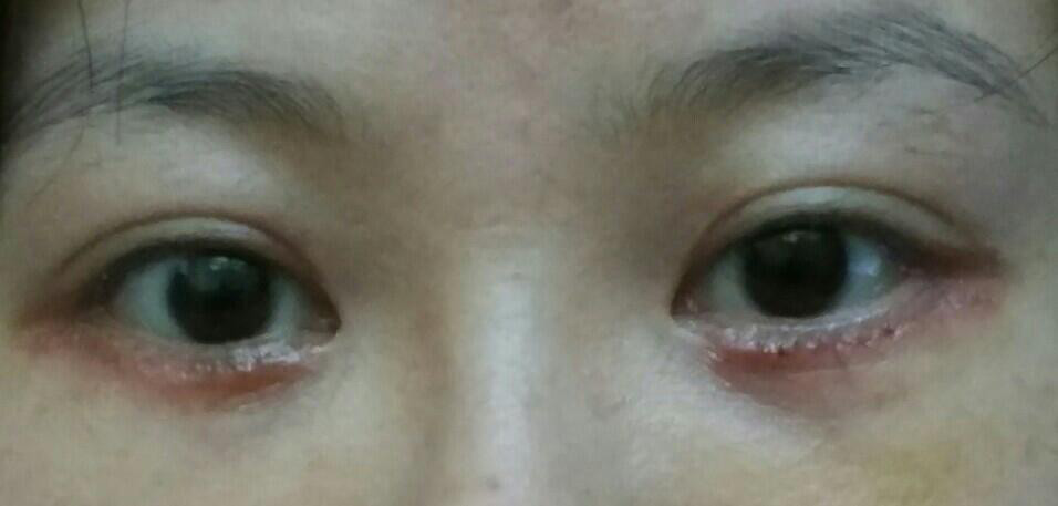做完祛眼袋手术后当天的照片以及至术后十天的