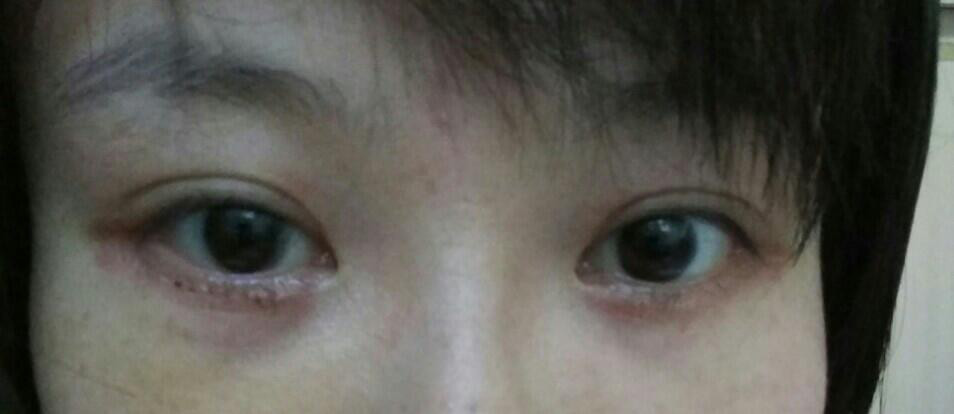 做完祛眼袋手术后当天的照片以及至术后十天的
