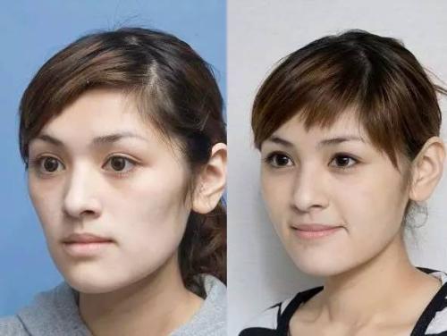 担心除泪沟风险?玻尿酸自体脂肪填充泪沟效果图