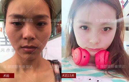 首尔丽格谁做颧骨好