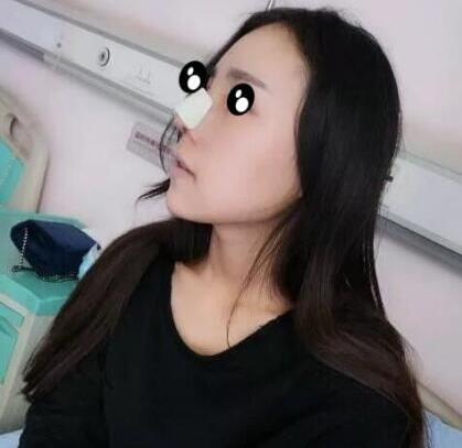 上海华美谢卫国隆鼻技术真像说的那么厉害吗?真人分享隆鼻过程
