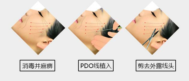 逆龄青春丨一次PPDO埋线提升 星宸整形让你的年纪成为秘密
