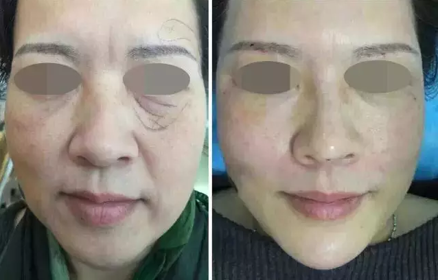 逆龄青春丨一次PPDO埋线提升 星宸整形让你的年纪成为秘密