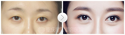 重庆星宸整形彭绍宗院长：越是人到中年越更需要做双眼皮