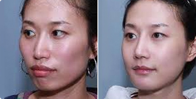 磨骨手术不危险，危险小姐姐就不来上海九院做磨骨了
