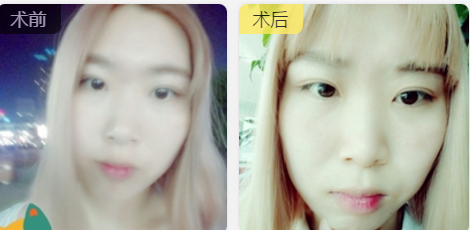 双眼皮怎么才好看，找杭州时光范眉清做合适自己的双眼皮