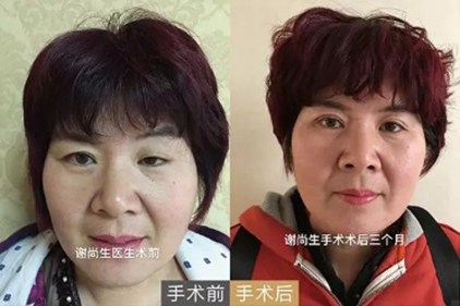 专注眼修复42年，谢尚生医师做的眼修复更好看