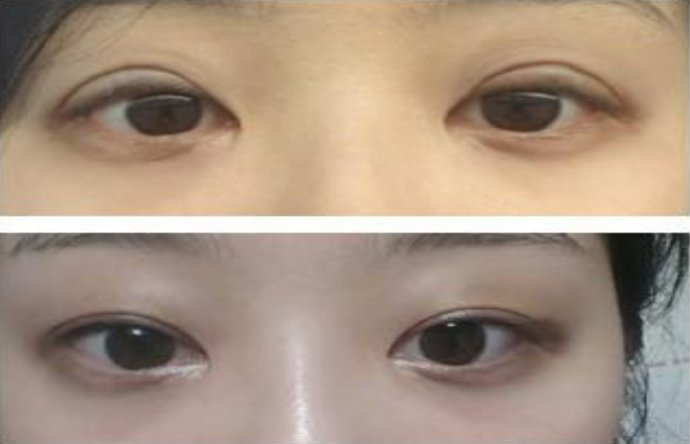 专注眼修复42年，谢尚生医师做的眼修复更好看