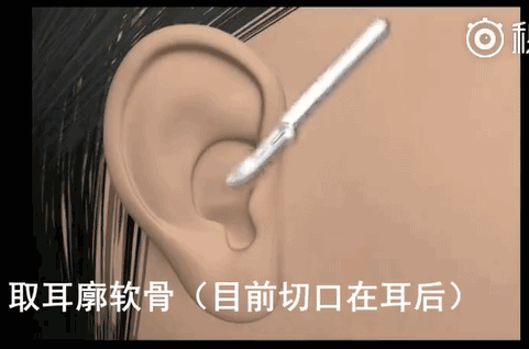 重庆华美是正规的吗?重庆华美整形医院隆鼻方案全过程
