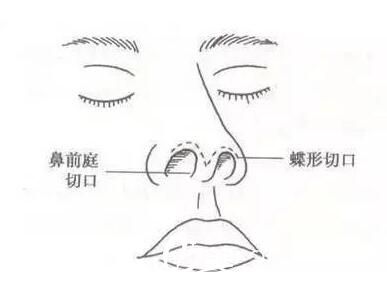 保山做鹰钩鼻手术术的优点有哪些，价格又是多少呢