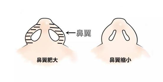 北京丽都整形自体耳软骨隆鼻技术怎么样？费用多少？