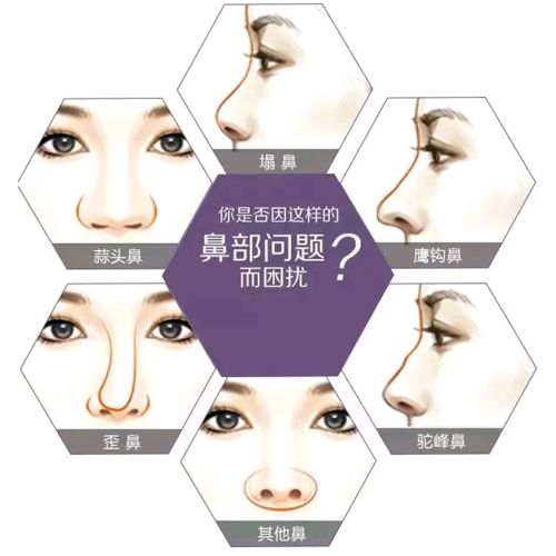 杭州丽人医疗美容医院鼻部整形技术怎么样？费用详解与术后效果展示