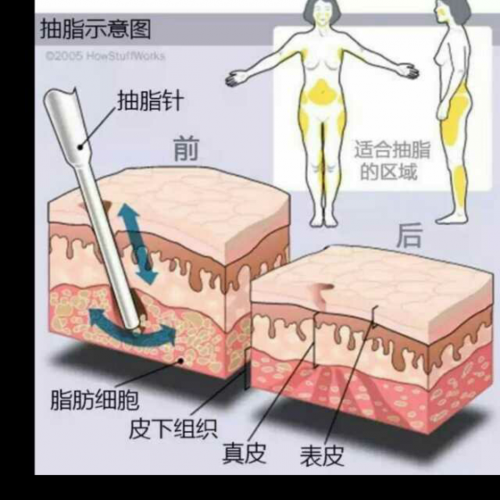 深圳联合丽格医疗整形美容医院埋线抽脂双眼皮手术费用贵吗