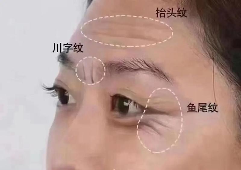 射频除皱价格费用多少？解析影响费用的因素