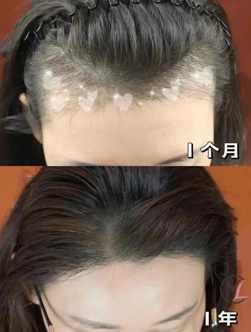 济南丽合医疗美容医院植发科怎么样？医生技术测评、案例细节公布
