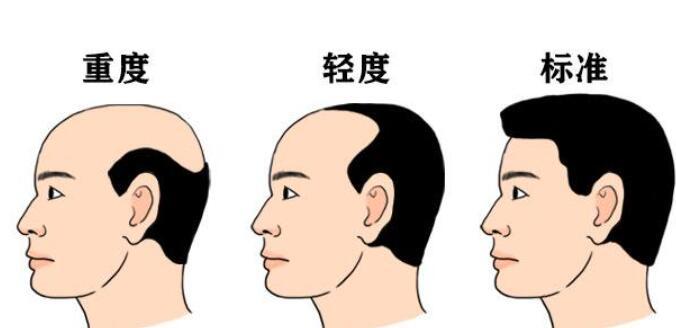 厦门哪个三甲医院种植发际线更专业一些(厦门种植发际线哪个医院好)