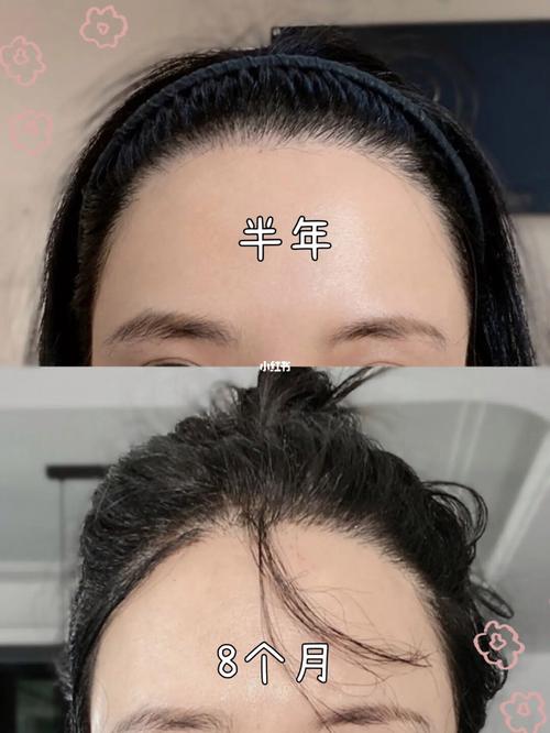 毛发移植手术一般需要多少钱(毛发种植手术多少钱)