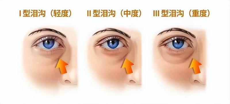 威海眼部黑眼圈泪沟去除术的价格因素是什么