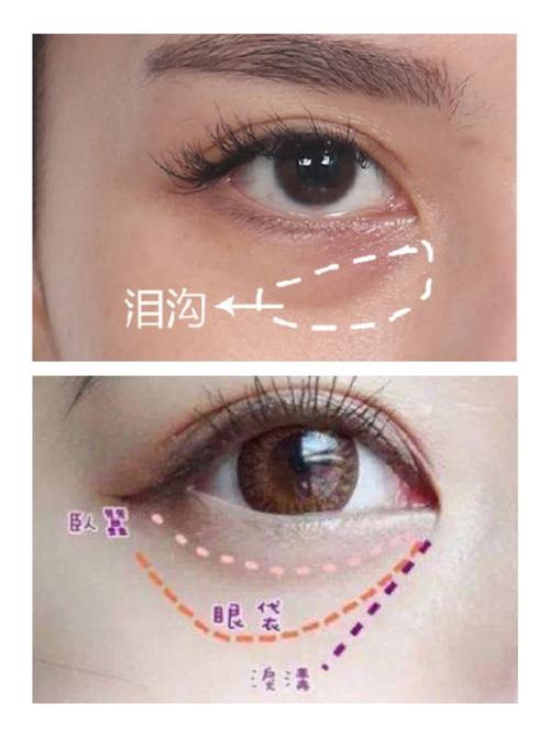 深圳填充泪沟矫正有副作用吗需要多少钱