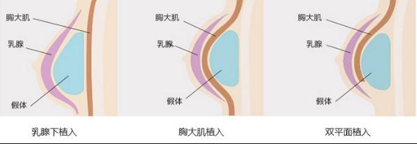 天津市河北区伊曼医学美容门诊部隆胸技术怎么样？