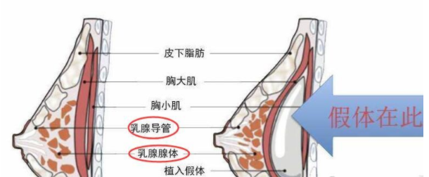 深圳隆胸修复手术费用详解：20240元起，如何避免高昂费用和手术风险