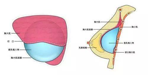 哈尔滨假体隆胸价格多少钱？详细价目表及解析