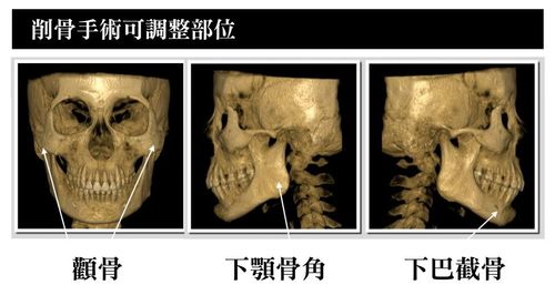 下颌角截骨手术费用费用多少？详解费用构成与影响因素