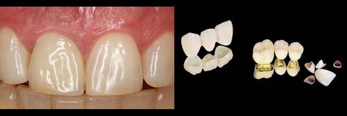 烤瓷牙种类大曝光及价格费用多少一览表