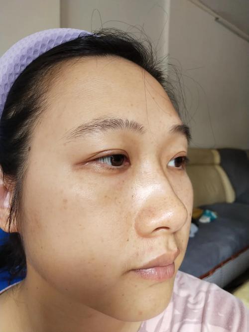 广州维生素e擦脸祛斑术大概要多少费用