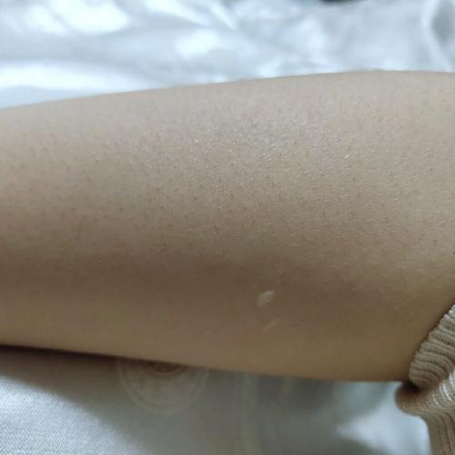 黄山市人民医院皮肤美容科费用多少？效果好不好？