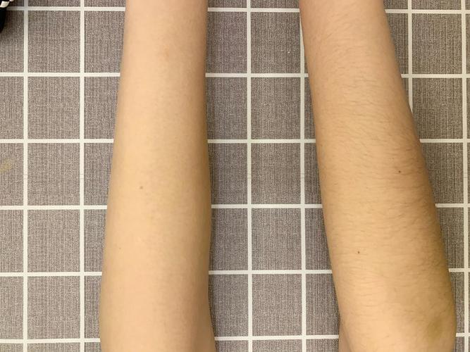 夏日脱毛新选择！冰点脱毛及鱼尾纹去除价格曝光