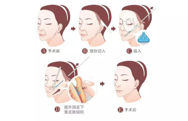 长治面部线雕提升的价格受到哪些方面因素影响